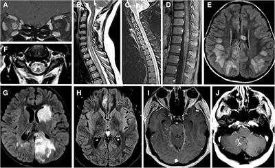 The Expanding Clinical Spectrum of Myelin Oligodendrocyte Glycoprotein (MOG) Antibody Associated Disease in Children and Adults